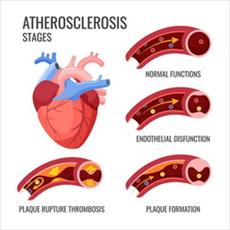 تحقیق آترواسكلروز (تصلب‌ شرايين) Atherosclerosis
